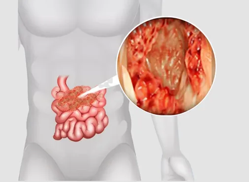 Small Intestinal Disorders